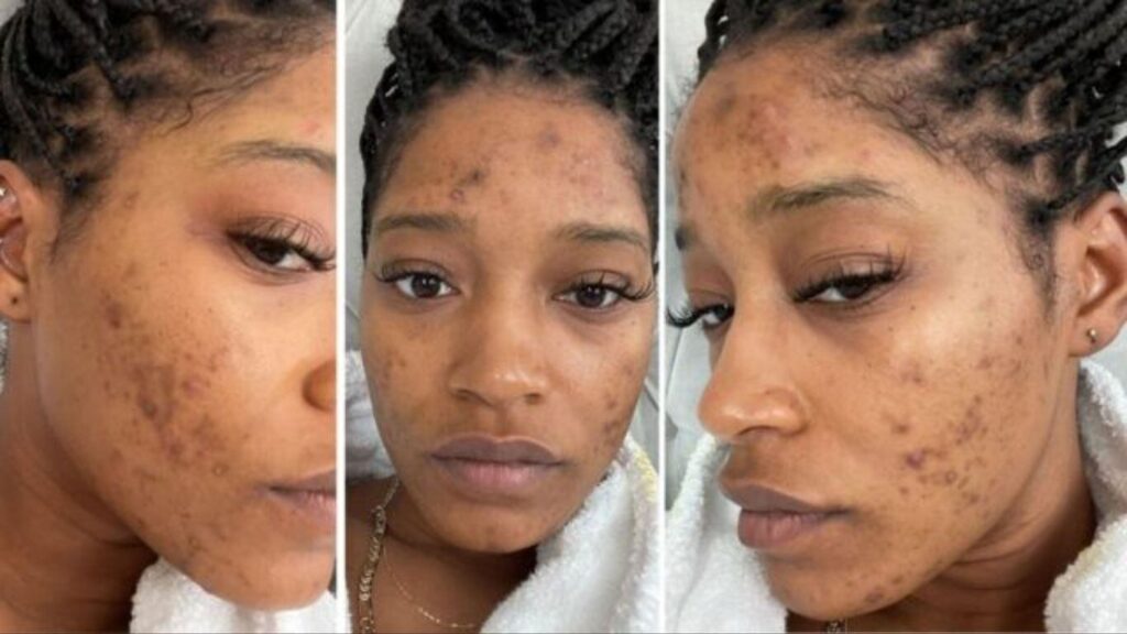 5 Celebrities With PCOS – And How They Manage This Condition